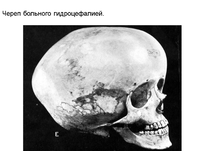 Череп больного гидроцефалией.